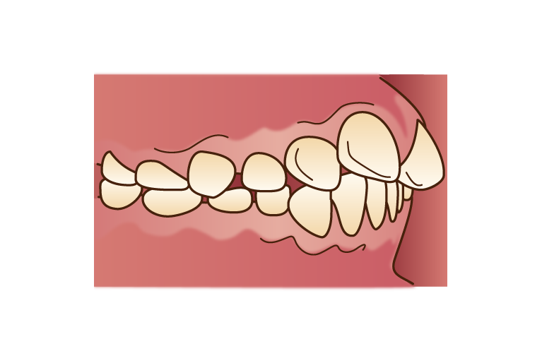上顎前突（じょうがくぜんとつ）