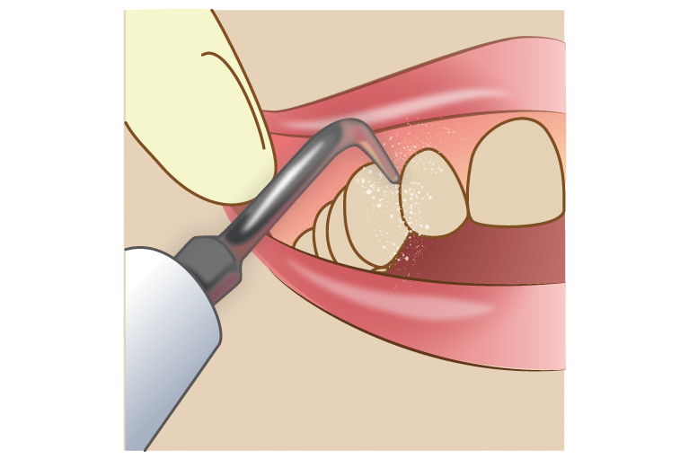歯周ポケットからプラークを採取する